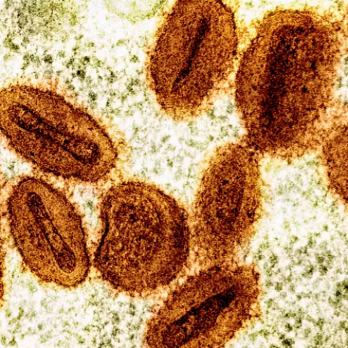 RN investiga caso suspeito de mpox em Mossoró