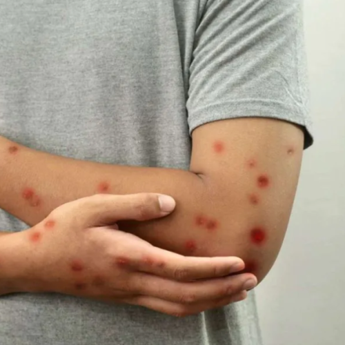 Sesap confirma primeiros casos de mpox no RN em 2026