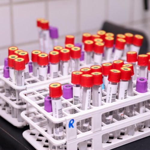 Prefeitura inicia coletas de exames em UBS’s de Parnamirim/RN